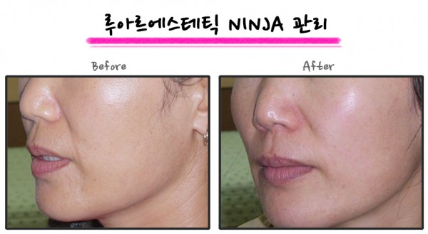 진피재생관리 닌자 5.jpg